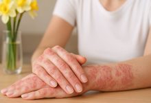 کل تار چیست و چه تأثیری بر درمان پسوریازیس دارد؟
