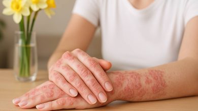 کل تار چیست و چه تأثیری بر درمان پسوریازیس دارد؟