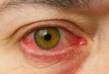 همه چیز درباره قطره چشمی لاکروسپورین
